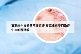 石家庄牛皮癣医院哪家好 石家庄有专门治疗牛皮的医院吗