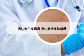 杏仁治牛皮癣吗 杏仁能治皮肤病吗