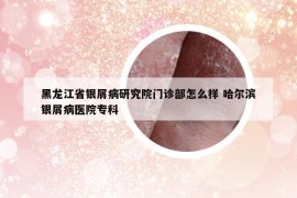 黑龙江省银屑病研究院门诊部怎么样 哈尔滨银屑病医院专科