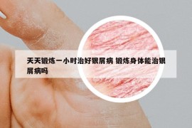 天天锻炼一小时治好银屑病 锻炼身体能治银屑病吗