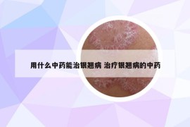 用什么中药能治银翘病 治疗银翘病的中药