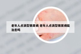 老年人点滴型银屑病 老年人点滴型银屑病能治愈吗