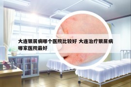 大连银屑病哪个医院比较好 大连治疗银屑病哪家医院最好