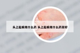 头上起癣用什么药 头上起癣用什么药膏好