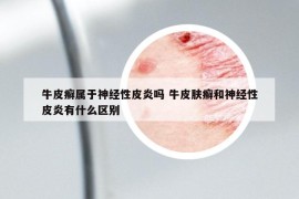 牛皮癣属于神经性皮炎吗 牛皮肤癣和神经性皮炎有什么区别