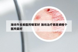 潍坊牛皮癣医院哪家好 潍坊治疗银屑病哪个医院最好