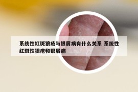 系统性红斑狼疮与银屑病有什么关系 系统性红斑性狼疮和银屑病