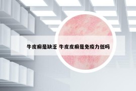 牛皮癣是缺乏 牛皮皮癣是免疫力低吗