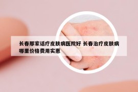 长春那家话疗皮肤病医院好 长春治疗皮肤病哪里价格费用实惠