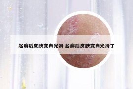 起癣后皮肤变白光滑 起癣后皮肤变白光滑了