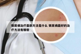 银屑病治疗最新方法是什么 银屑病最好的治疗方法有哪些