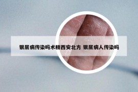 银屑病传染吗术精西安北方 银屑病人传染吗