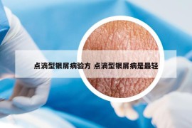 点滴型银屑病验方 点滴型银屑病是最轻