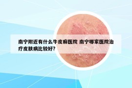 南宁附近有什么牛皮癣医院 南宁哪家医院治疗皮肤病比较好?