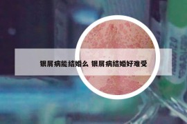 银屑病能结婚么 银屑病结婚好难受