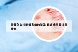 需要怎么控制银宵病的复发 银宵病需要注意什么