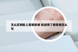 怎么区别脸上是银屑病 脸部得了银屑病怎么写