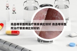 南昌哪家医院治疗银屑病比较好 南昌哪家医院治疗银屑病比较好的