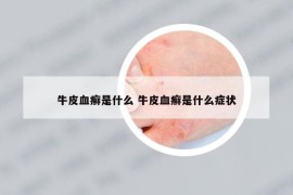 牛皮血癣是什么 牛皮血癣是什么症状