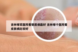 吉林哪家医院看银屑病最好 吉林哪个医院看皮肤病比较好