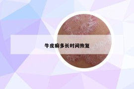 牛皮癣多长时间恢复