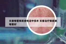 长春哪看银屑病电话中技术 长春治疗银屑病哪里好