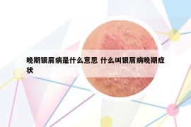 晚期银屑病是什么意思 什么叫银屑病晚期症状