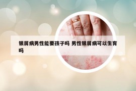 银屑病男性能要孩子吗 男性银屑病可以生育吗