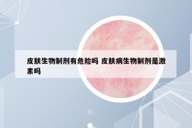 皮肤生物制剂有危险吗 皮肤病生物制剂是激素吗