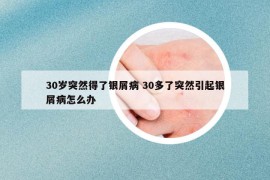 30岁突然得了银屑病 30多了突然引起银屑病怎么办