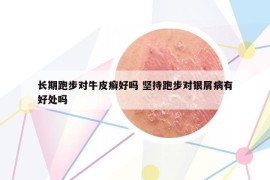 长期跑步对牛皮癣好吗 坚持跑步对银屑病有好处吗