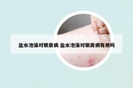 盐水泡澡对银屑病 盐水泡澡对银屑病有用吗