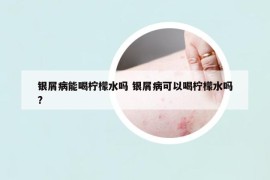 银屑病能喝柠檬水吗 银屑病可以喝柠檬水吗?