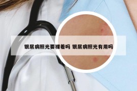 银屑病照光要裸着吗 银屑病照光有用吗