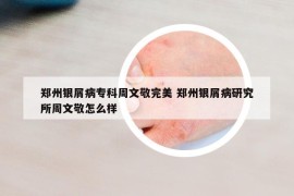 郑州银屑病专科周文敬完美 郑州银屑病研究所周文敬怎么样