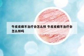 牛皮皮癣不治疗会怎么样 牛皮皮癣不治疗会怎么样吗