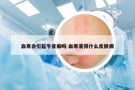 血寒会引起牛皮癣吗 血寒易得什么皮肤病