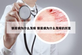 银屑病为什么发痒 银屑病为什么发痒的厉害