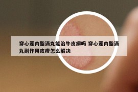 穿心莲内酯滴丸能治牛皮癣吗 穿心莲内酯滴丸副作用皮疹怎么解决