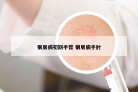 银屑病初期手臂 银屑病手肘