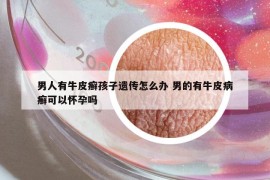 男人有牛皮癣孩子遗传怎么办 男的有牛皮病癣可以怀孕吗