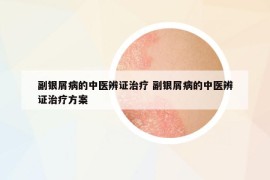 副银屑病的中医辨证治疗 副银屑病的中医辨证治疗方案