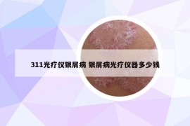 311光疗仪银屑病 银屑病光疗仪器多少钱