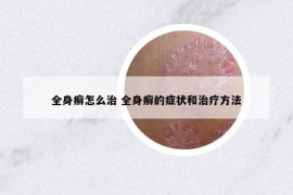 全身癣怎么治 全身癣的症状和治疗方法