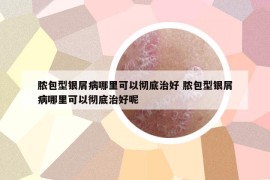 脓包型银屑病哪里可以彻底治好 脓包型银屑病哪里可以彻底治好呢