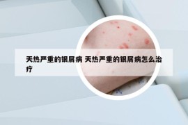 天热严重的银屑病 天热严重的银屑病怎么治疗