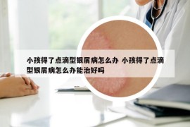 小孩得了点滴型银屑病怎么办 小孩得了点滴型银屑病怎么办能治好吗