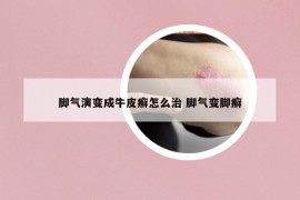 脚气演变成牛皮癣怎么治 脚气变脚癣