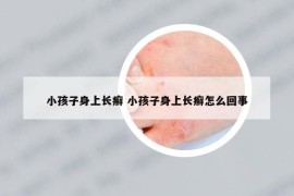 小孩子身上长癣 小孩子身上长癣怎么回事