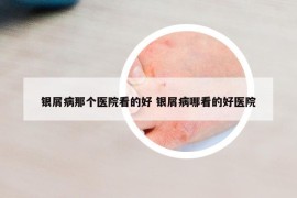 银屑病那个医院看的好 银屑病哪看的好医院